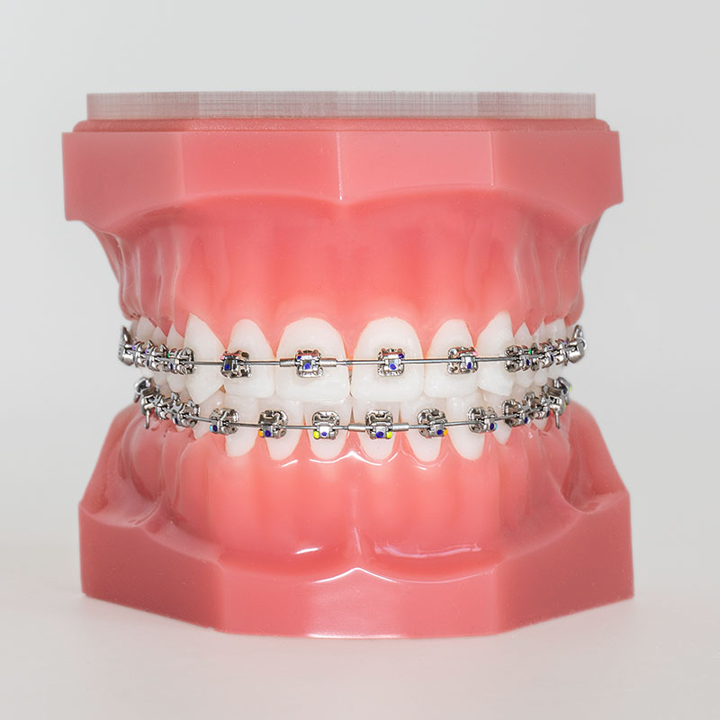 A typodont with damon braces on is shown